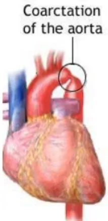 Figure 2-7 Coarctation de l’aorte au niveau de l’arc aortique  Adapté de : http://nt.vitaba.com/coarctation-de-laorte-3 