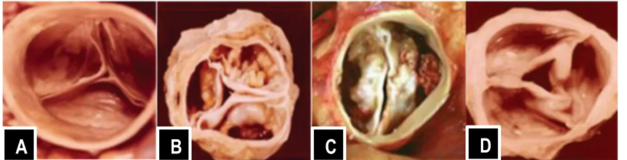 Figure 3-2 Les principales étiologies de la sténose aortique  