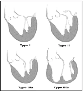Figure 5 : Classification de l'insuffisance mitrale selon Carpentier ( Image tirée  d’après Fedak,Paul W.M  et coll