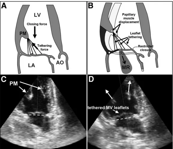 Figure 10  : Étirement des feuillets de la valve mitrale. Fermeture normale de la  valve mitrale (A, C) ; rétraction des muscles papillaires causant un étirement des  feuillets de la valve mitrale (D) et, si assez sévère, IM (B)