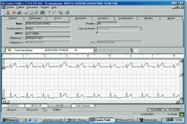 Figure  n°2 :  Électrocardiogramme  «  SURVCARD  »,  par  modem  sur  un  poste  informatique dédié 