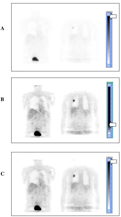 Figure  4.6.  Coupes  coronales  d’une  TEP  au  18 FDG  réalisée  chez  un  patient  souffrant  d’un  CPNPC