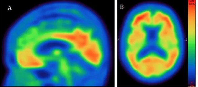 Figure 3. Positive amyloid-PET study using NAV4694. This test shows significant deposition of fibrillary  amyloid plaques in the cingulate cortex (A) as well as diffusely throughout the brain (B)