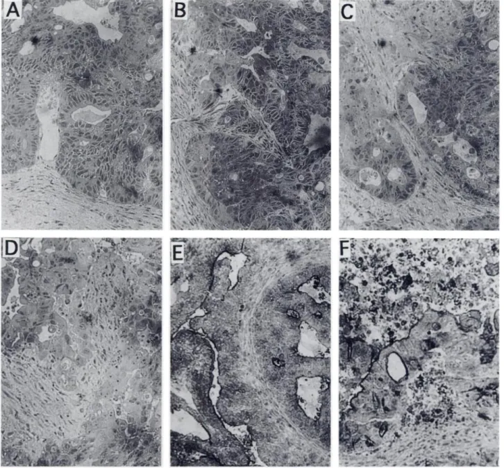 Fig. 5. Histology (A-D) and anti-CEA immunohistochemistry (E and F) of human carcinoma Col 12 xenografts that were untreated (A and A) or irradiated with 6 Gy (B), 15 Gy (C) and 30 Gy (D and F)