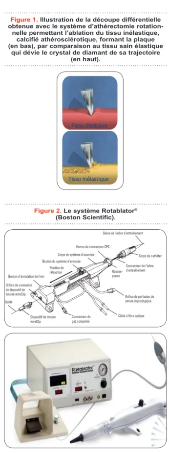 Figure 1. Illustration de la découpe différentielle  obtenue avec le système d’athérectomie  rotation-nelle permettant l’ablation du tissu inélastique, 