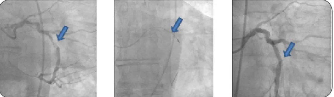 Figure 4. Résultats avant et après rotablation d’une lésion coronaire   calcifiée. a) lésions sévèrement calcifiées étagées de l’artère circonflexe  et de la première marginale, b) passage de la fraise à 180000 tours/minute, 