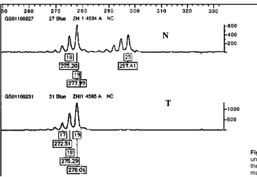Figure 2 HUMARA PCR amplification of undigested samples showing LOH for the AR gene in struma ovarii