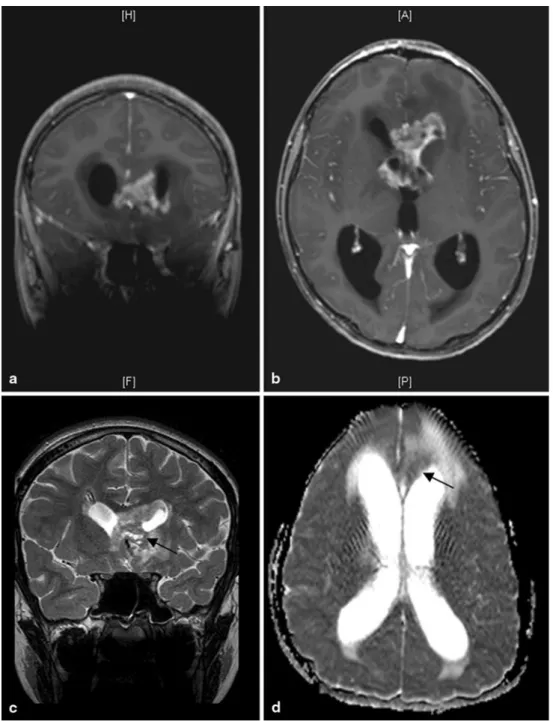 Fig. 1  Coronal (a) and axial  (b) postcontrast T1-weighted  slices showing bilateral frontal  periventricular lesion infiltrating  the genu of corpus callosum, the  floor and the anterior wall of the  left frontal horn, and the  tumor-associated vasogenic