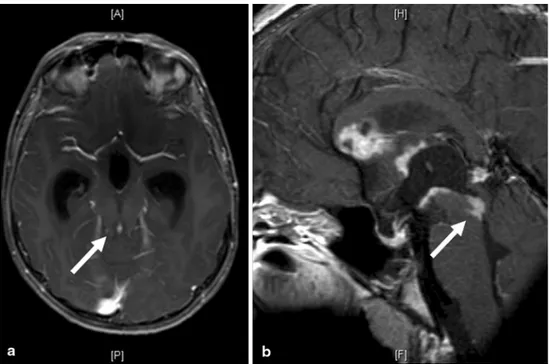 Fig. 2  Postcontrast T1-weighted  axial (a) and midline sagittal (b)  slices showing the tumor  seed-ing into the Sylvian aqueduct  responsible for the supratentorial  hydrocephalus (arrows), the  in-filtration of corpus callosum, the  tumor lining the ant