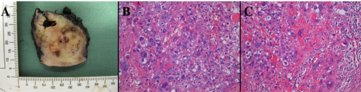Fig. 2. Immunophenotype of tumor cells (HIS, 100×). A, B &amp; C. The staining of hCG (A) and hPL (B) is focally positive