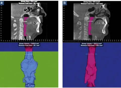 Fig. 5: Upper airway evaluation of two patients.