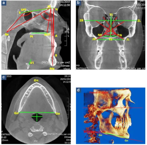 Fig. 1: a–d: angles and distances measured on CBCT images.