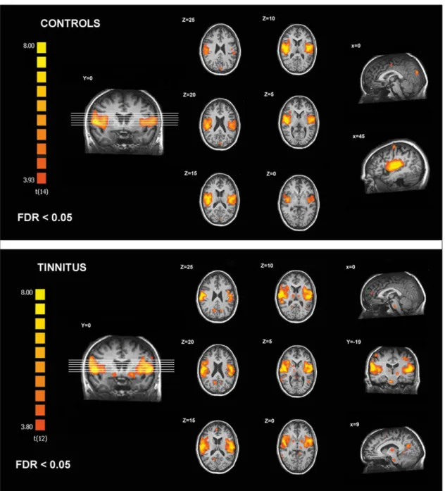 Figure 2. Regions of the auditory resting state network identified in controls and chronic tinnitus patients.