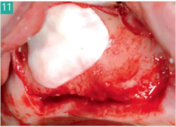 Fig. 12 : Les sutures sont réalisées avec de la soie 4/0 en alternant des points simples et des points de 