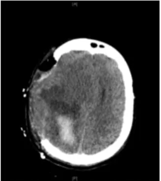 Figure 1. DR's CT scan 15 days after her stroke (January 2014) showing right frontoparietal lesion  traces (the right is on the left)