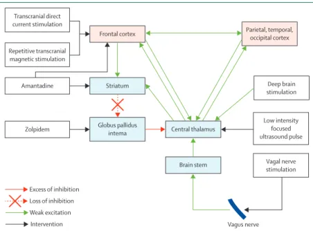 Figure 3: The mesocircuit fronto-parietal model for mechanisms underlying the effects of interventions in  severe brain injuries