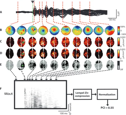 Fig. 1. The PCI is calculated from TMS-evoked potentials. (A) The black traces show the super- super-position of the averaged TMS-evoked potentials (150 trials) recorded from all EEG channels (butterfly plot of 60 channels) in one representative subject du