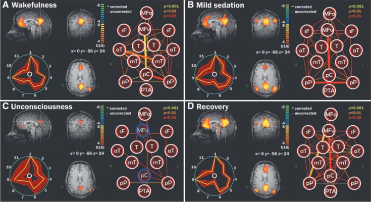 FIG. 1. Default mode network (DMN) integrity during wakefulness, mild sedation, unconsciousness, and recovery