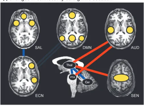 FIG. 5. Summary of propofol- propofol-induced connectivity changes. (A) Connectivity increases (red lines) and decreases (blue lines), as well as decreased anticorrelation (thin blue double lines) during mild sedation as compared to wakefulness