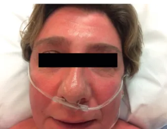 Fig. 1. — Facial erythema, downward diffusing.