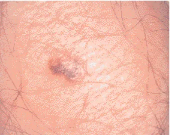 Fig. 1. Mélanome cutané de petite taille chez un adepte du bronzage.
