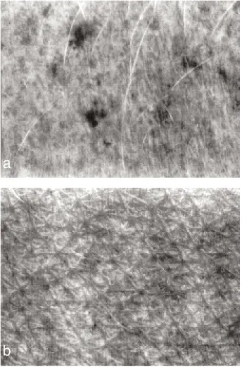 Fig. 4. Hétérochromie de la peau révélée par la transmission de la lumière ultraviolette de grande longueur d’onde dans la peau