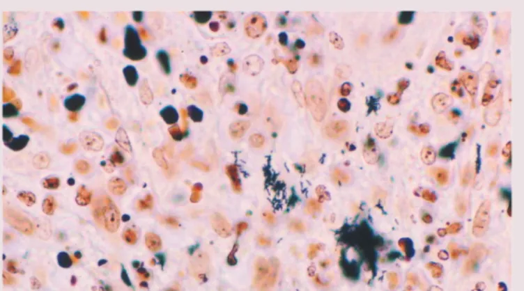 Figure 2 Immunohistochemical identification of B henselae in a case of  cat scratch disease