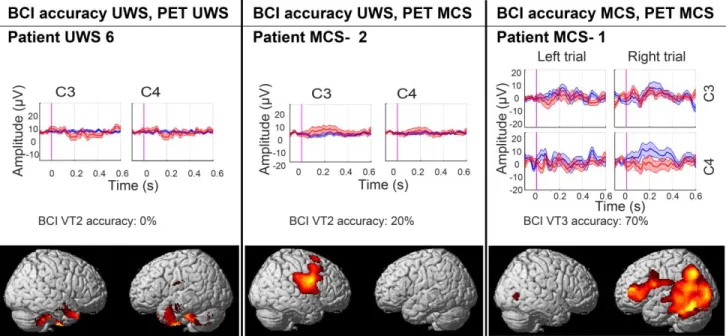 Figure 2. BCI performance and areas of preserved (in red-yellow) cerebral glucose metabolism 280 