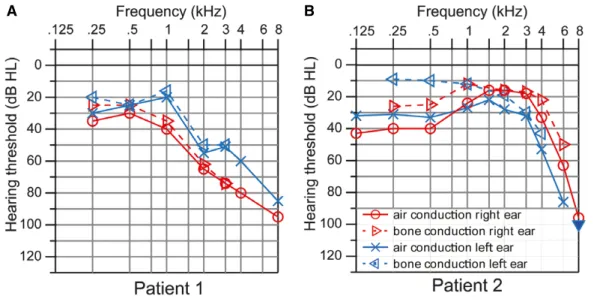 Figure 7 . Hearing impairment in LRBA-deficient patients.