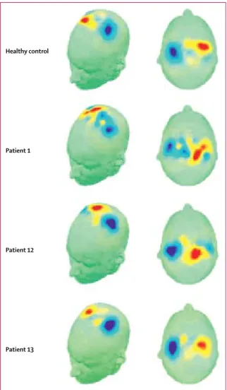 Figure 2: Modulation of the appropriate frequency bands of the EEG signal  that are associated with motor imagery in three patients and one healthy  control participant