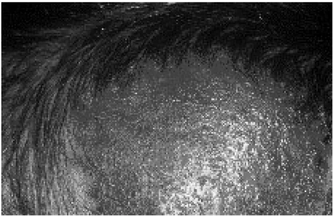 Fig. 3. Kérion à Trichophyton ochraceum.