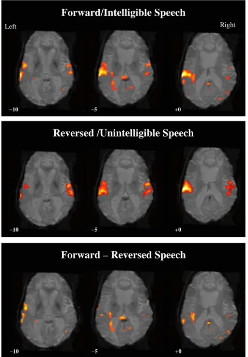 Fig. 2.  Regions of activation noted in patient AZ when exposed to spoken narratives. The top panel shows robust activation in left  temporal association cortex observed during presentation of comprehensible speech