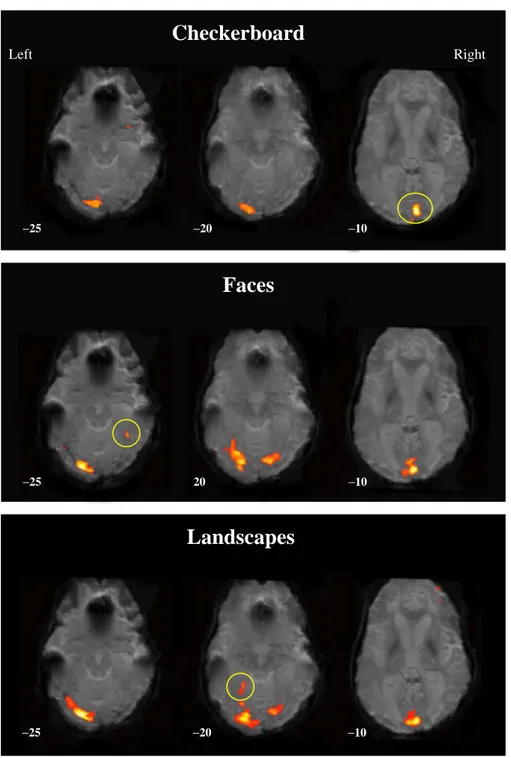 Fig. 3.  Regions of activation noted in patient AZ in response to visual stimuli. The top panel shows bilateral activation in the primary  cortex observed during exposure to ﬂashing checkerboards