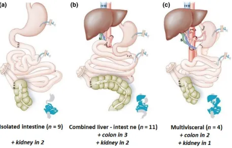 Figure 1 Three types of intestinal transplantation were performed in the Belgian experience