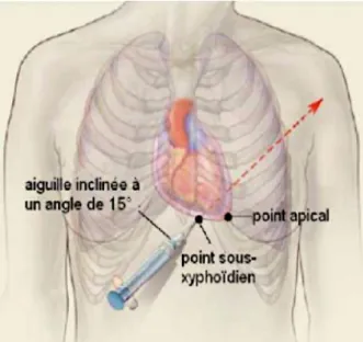 Figure 3. Drainage péricardique percutané.