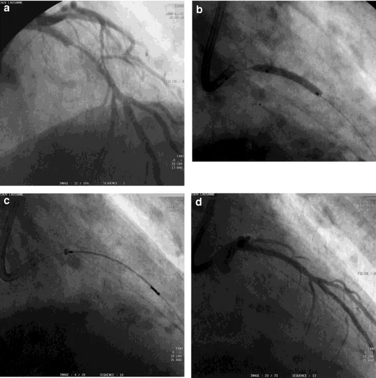 Fig. 1. a: Coronary angiogram of a significant in-stent reste- reste-nosis in the left anterior descending coronary artery