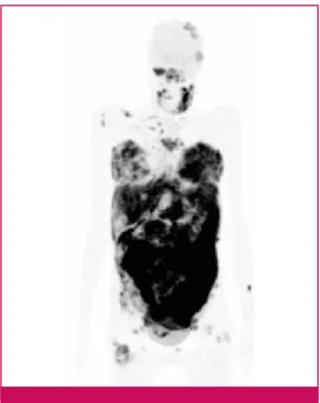 Figure 1. Illustration of a pathological preparation of Burkitt’s  Lymphoma (haematoxylin and eosin, 400x)