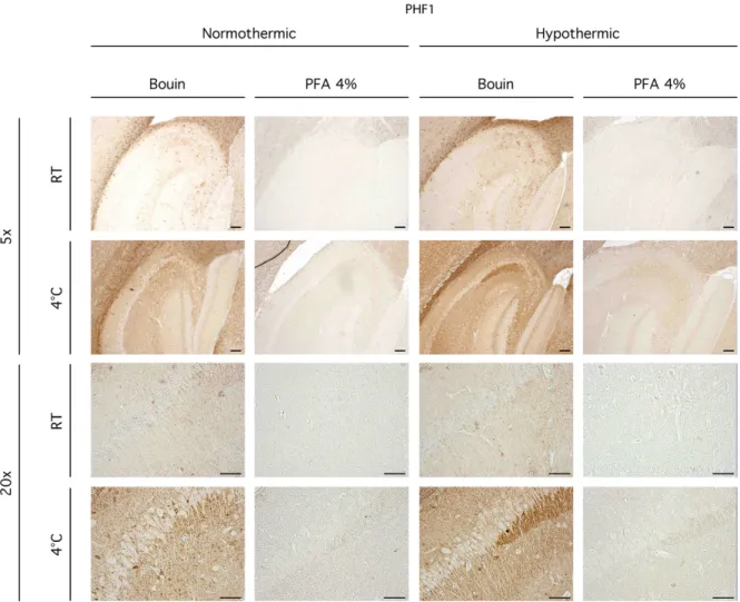 Figure 6. PHF1 staining by DAB in perfused WT mice.  Sagittal sections (5X and 20X)  of  WT  mice  hippocampi  are  shown  using  PHF1  antibody    (phospho  S396/S404)  in  immunohistochemistry  (DAB)  for  the  following  conditions:  Bouin  at  4°C,  Bo