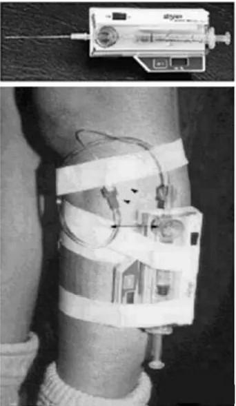 Figure 4 : Moniteur de pression digitale qui peut être relié soit à un cathéter fendu, soit à une aiguille présentant une fenêtre latérale.