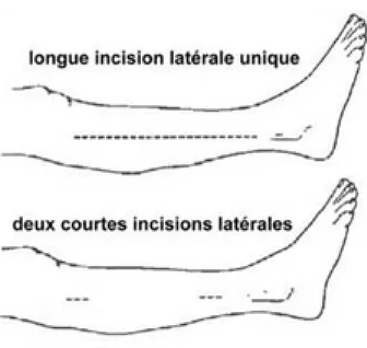 Figure 5 : Traitement chirurgical du syndrome de loge au niveau de la jambe. Les compartiments antérieur et latéral peuvent être libérés soit par une longue incision latérale unique soit par deux incisions longitudinales plus courtes.