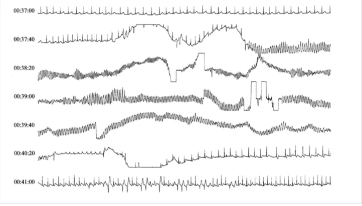 Figure 2. Electrocardiogramme à 12 dérivations obtenu chez la patiente ayant présenté une torsade de pointe montrant un allongement de l’intervalle QT (630 ms)  avec ondes T crochetées dans les dérivations précordiales.