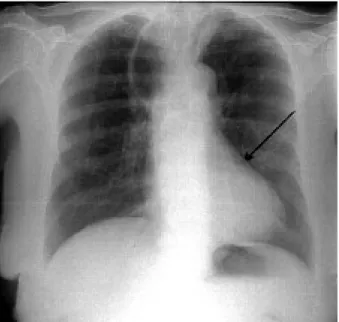 Fig. 1. Pneumomédiastin