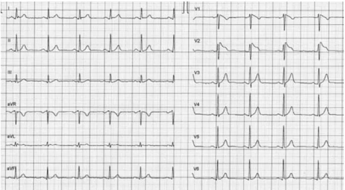 Fig. 1. Syndrome de Brugada : aspect typique de l’électrocardiogramme.