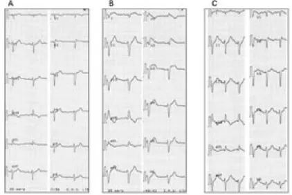 Fig. 3. Induction d’une tachycardie ventriculaire polymorphe chez un sujet asymptomatique, avec une électrocardiogramme de base typique d’un syndrome de Brugada.
