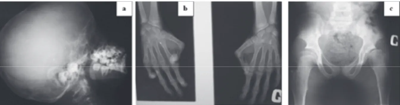 Figure 3 : Radiographies de la patiente atteinte du syndrome d’Hutchinson-Gilford. (a) Hypoplasie mandibulaire avec malposition des dents;