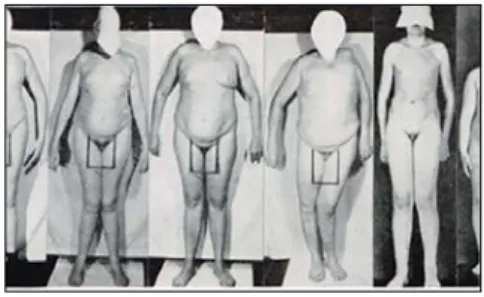 Figure 4: Patients historiques  décrits par Kallmann, et al. (4 frères  et 2 neveux) qui associaient un  hypogonadisme et une anosmie avec  d’autres traits, tels que la présence  de syncinésies, de retard mental et de  cécité aux couleurs (17).