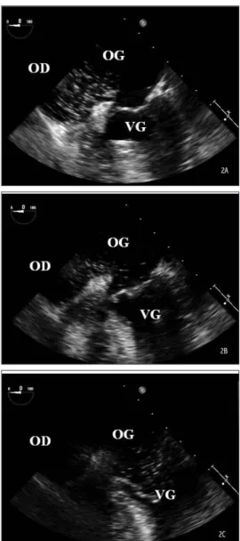 Figure 2. Echographie cardiaque transoesophagienne, réalisée au lit de la  patiente, coupes à 0°, séquence rapide de 3 images se suivant de moins de  3 battements cardiaques dans le temps