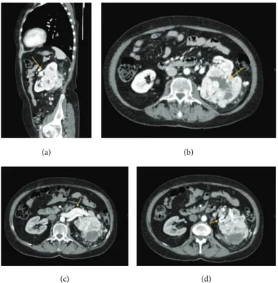 Figure 2: Images show the contrastographic behavior of the renal lesion and its relations with the surrounding anatomical structures