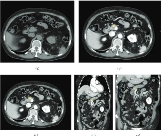 Figure 3: Images show the presence of a round-lesion at the pancreatic istm; the lesion hypodense in the precontrast study (a), appeared hypervascularized in all the three phases of the exam ((b), (c), (d), and (e))