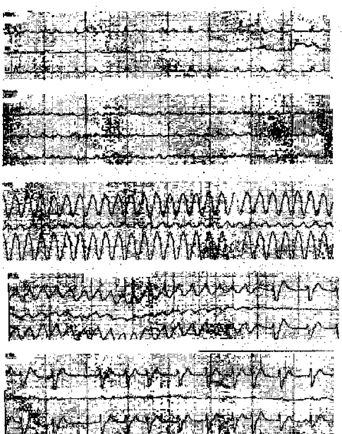Fig 2. Détails des enregistrements holter. Le premier encart (# 29) montre la fibrillation auriculaire (FA) à réponse ventriculaire moyenne; sur le second (# 30), on constate une accélération de la réponse ventriculaire; sur le troisième (# 31) apparaît la